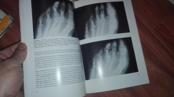 93627794_5e9192d7e80254-04631250IMG_20200410_22.jpg Arthritis Psoriatica